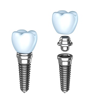 Implant Dentistry In Astoria, NY | Steven B. Manson, DDS, FAGD